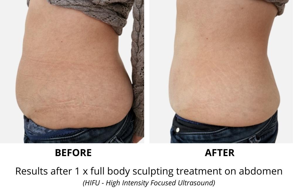Non-Surgical Body Sculpting: What is It and How is It Done?