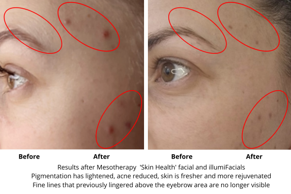 advanced facial aesthetics treatments - before and after