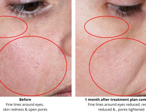 A client’s skin rejuvenation treatment journey using Celluma LED light therapy