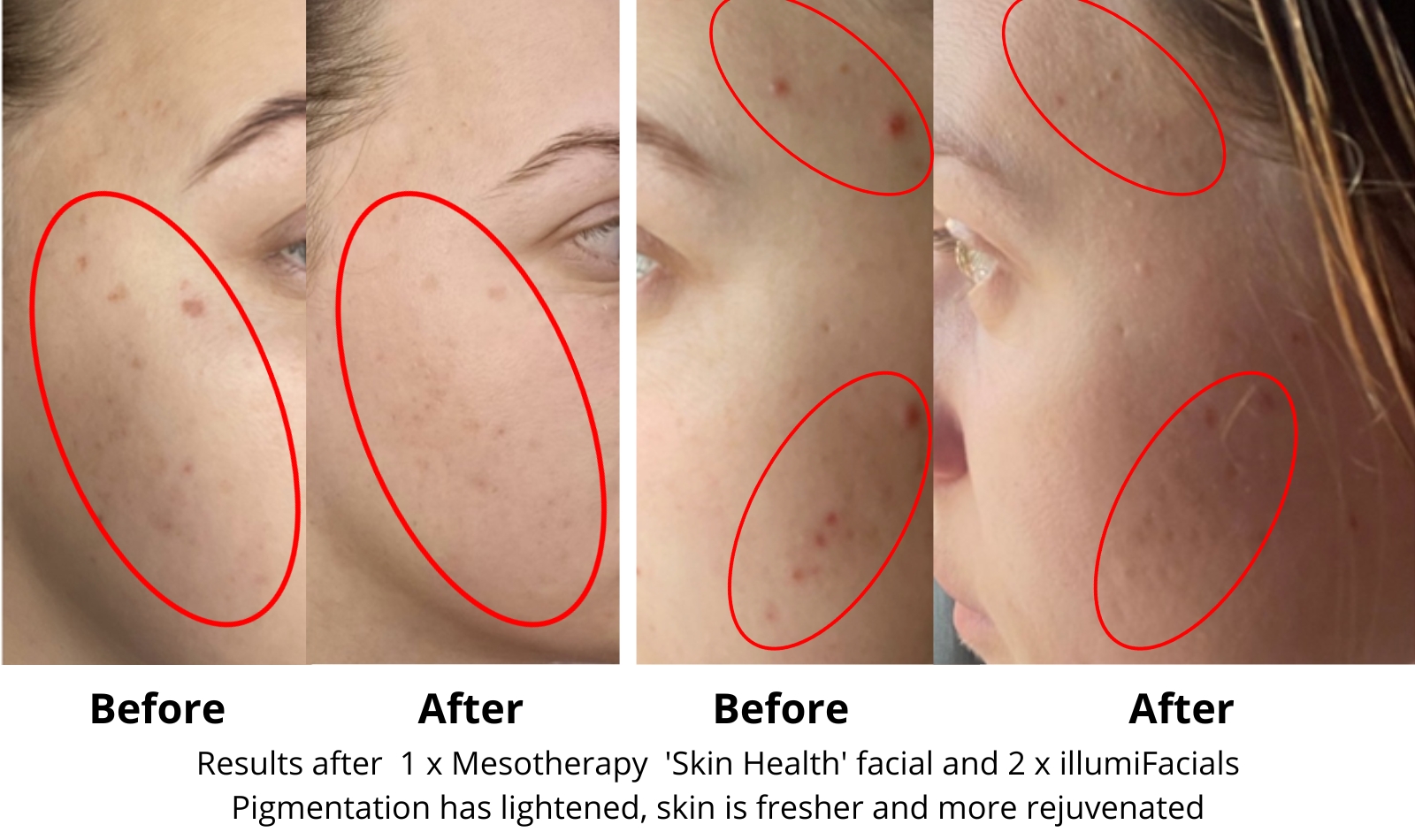 Aesthetic skin treatment before and after