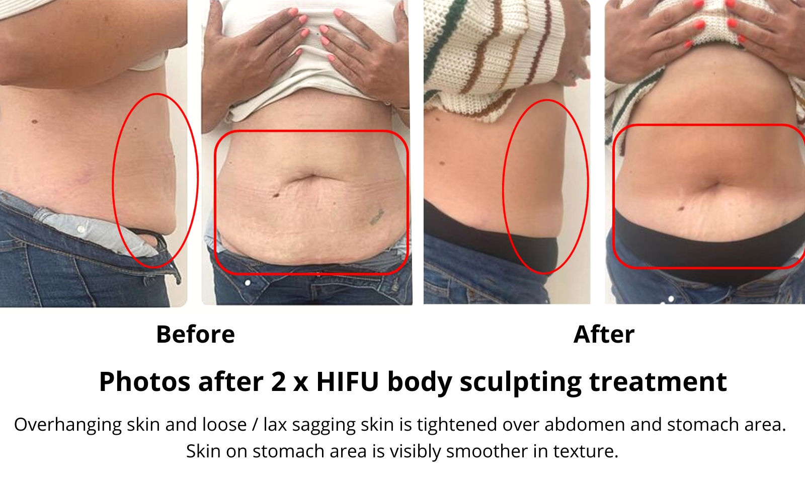 HIFU body sculpting before & after photos