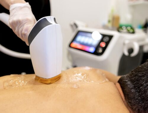 IPL back hair removal: A client’s journey to reduce unwanted back hair and boost confidence