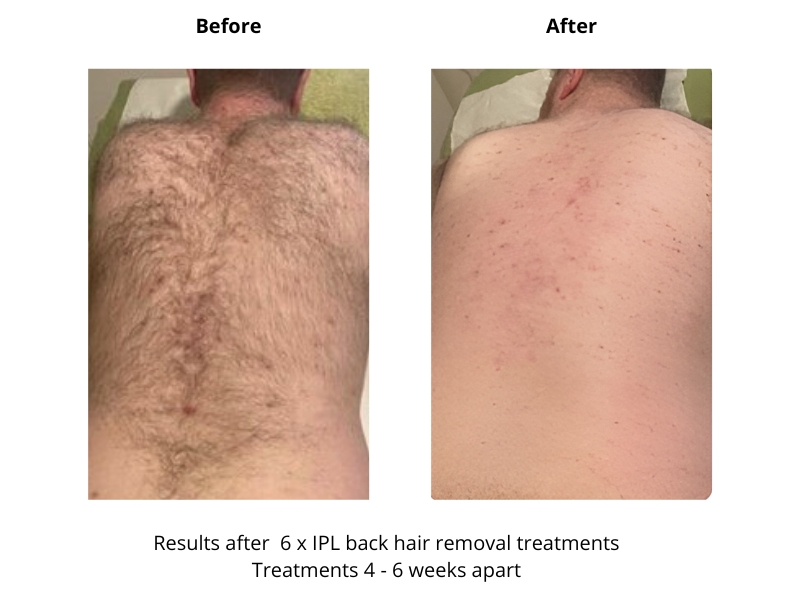 IPL back hair removal treatment before and after