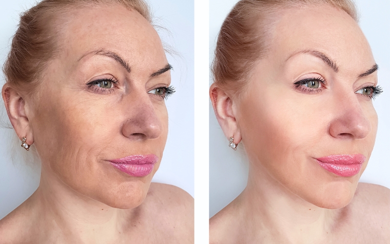 Anti-wrinkle treatment Basingstoke