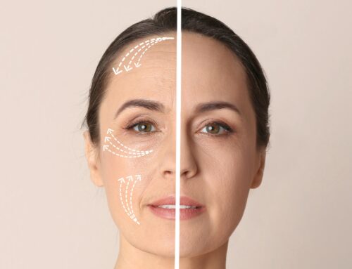 RF microneedling treatment: the ultimate anti-aging solution for natural skin rejuvenation